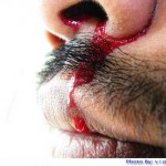 Nose bleeding